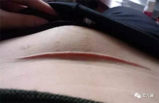 剖腹产伤疤怎么恢复好,剖腹产伤疤修复方法