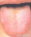 中医舌诊图谱100例,靠谱中医史上最全高清舌诊图谱