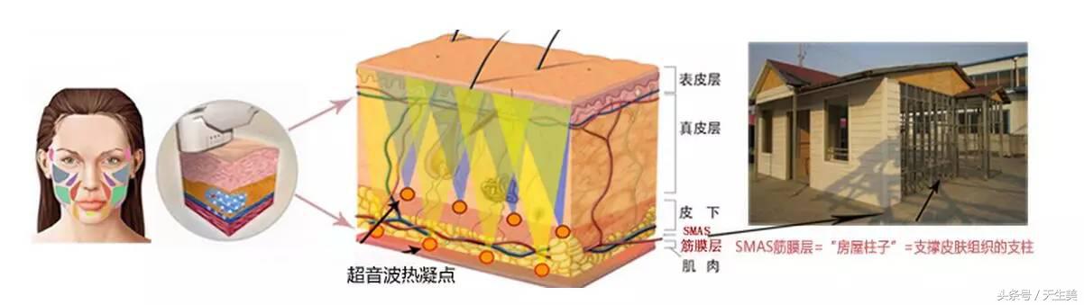 超声刀值得做吗 (超声刀怎么样啊)