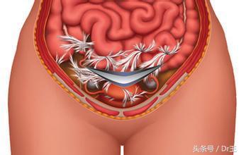 剖腹产后粘连怎么检查,剖腹产后导致肠子粘连怎么办
