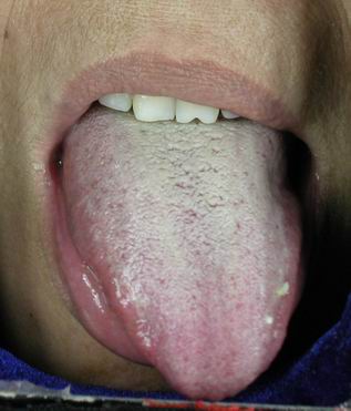 舌头有突起是什么病,舌头有这些表现或是疾病征兆