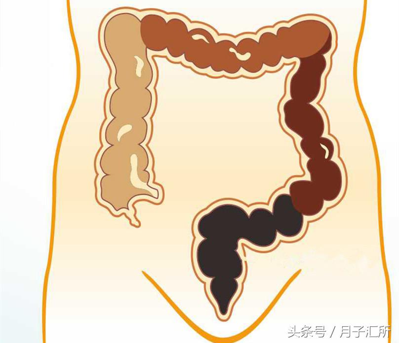 产后肛裂痔疮怎么办,便秘后肛裂了怎么办