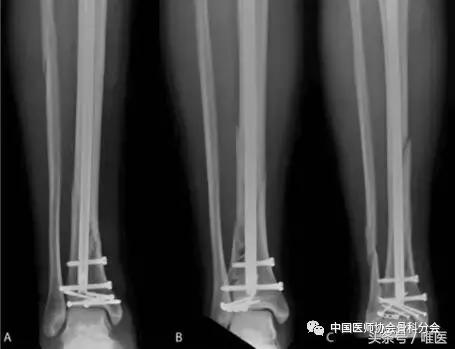 胫骨骨折髓内钉固定怎么锻炼,胫骨骨折髓内钉固定牢固吗