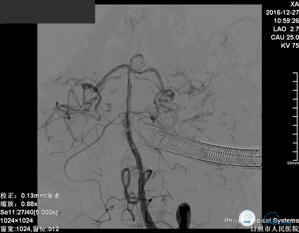 颈动脉瘤介入栓塞康复后可活多久,动脉瘤微创栓塞术全过程