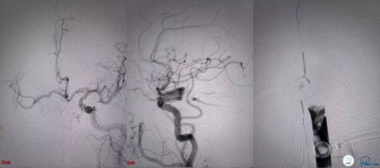 一例急性基底动脉尖综合征患者的支架取栓治疗
