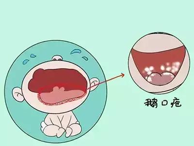鹅鹅鹅鹅口疮，你需要知道这些