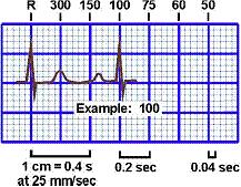 郭雅卿零基础心电图教学口诀,郭老师教你心电图口诀