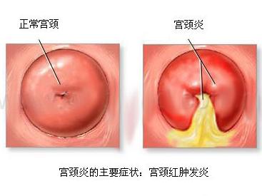 妇科炎症备孕操,妇科炎症影响备孕吗