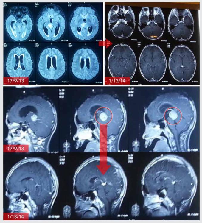 脑胶质瘤电场治疗中还有放疗吗,脑胶质母细胞瘤可否行电场治疗