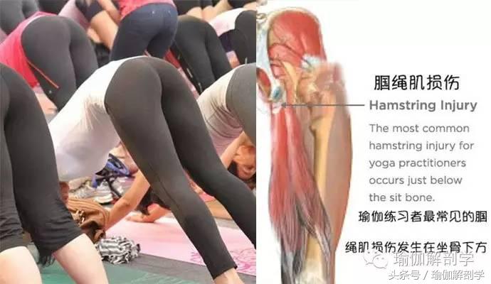 大腿后侧拉伤了怎么办快速缓解,大腿后侧拉伸筋疼怎么回事