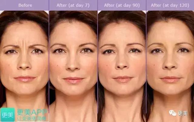 朋友圈肉毒素代购，白毒粉毒绿毒蓝毒到底靠不靠谱？