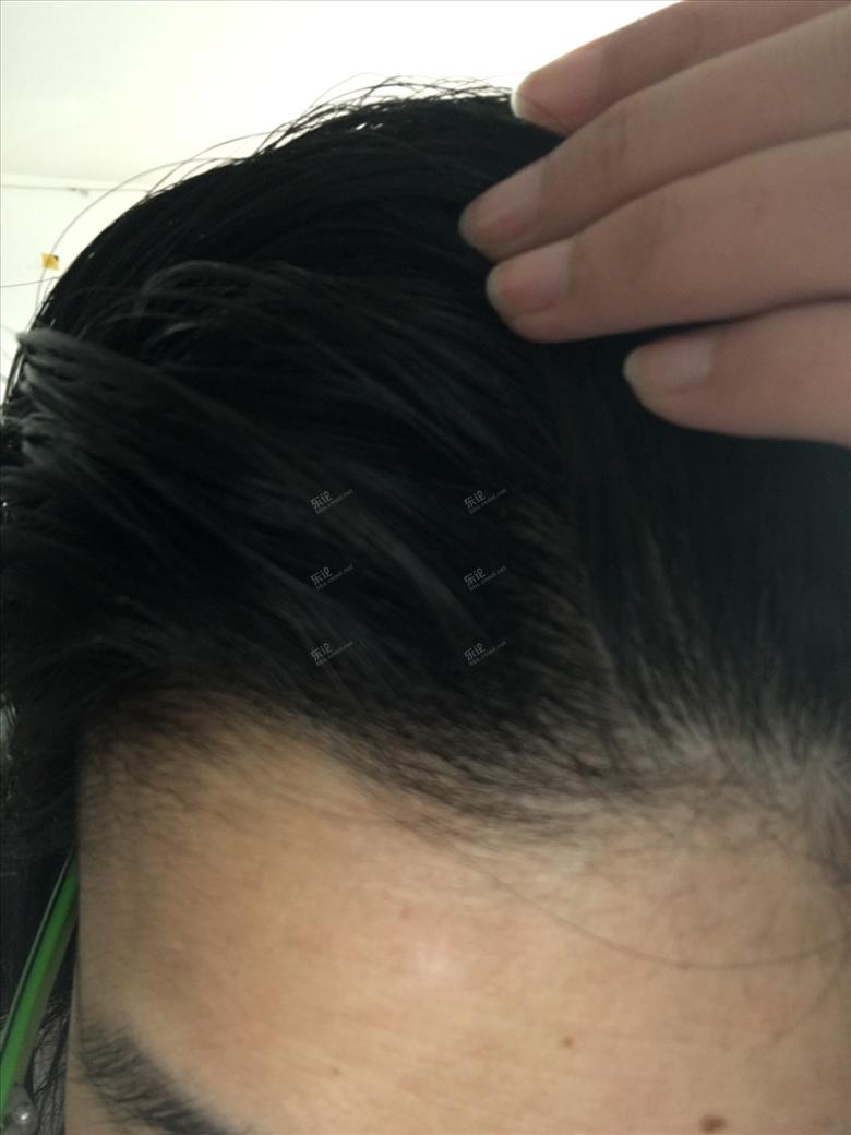 中医治头皮屑最快的妙招,头皮干燥头皮屑多偏方