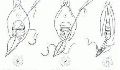 产后侧切缝线是用的什么线,产后妈妈侧切后的护理