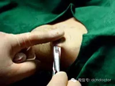 治足跟痛绝招,治足跟痛偏方视频