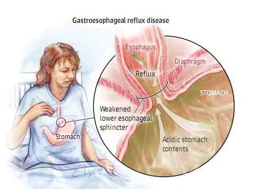 西苑医院消化科唐旭东教授:胃食管反流患者饮食需注意四个有