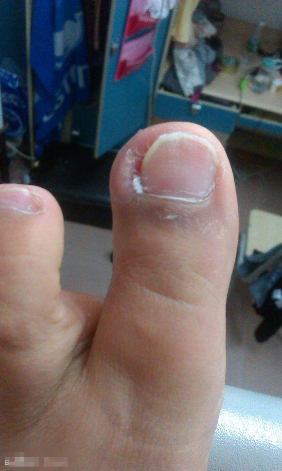 甲沟炎塞棉花法管用吗,甲沟炎塞棉花视频教程