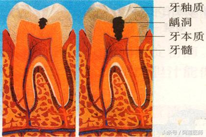 龋齿是成年人易得还是儿童易患,成人和小孩哪个更容易得龋齿