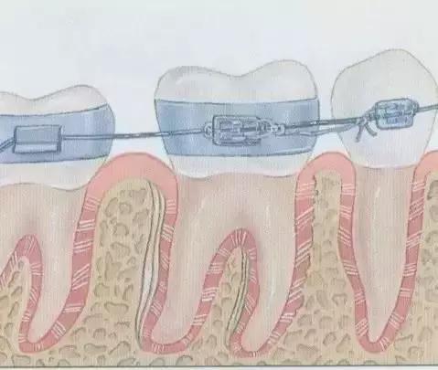 牙套上有钢丝怎么处理,钢丝牙套太丑怎么办