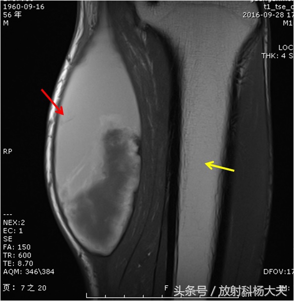 搬砖撞到小腿，拍片骨头没事，一周后腿肿，核磁发现问题