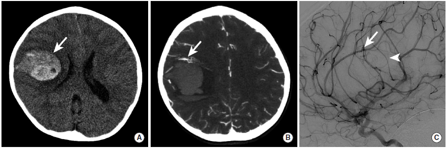 多图颅内出血影像学表现大全,头被撞后颅内出血有什么表现