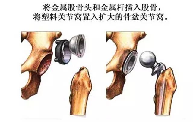 北京积水潭股骨头坏死的治疗方法,北京积水潭专家讲股骨头坏死三期