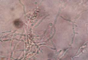 有一种病叫红斑丘疹,边界清晰发痒红斑有丘疹是湿疹吗