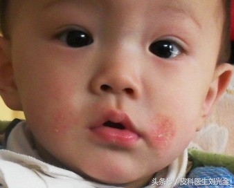宝妈如何对抗婴儿湿疹,宝妈课堂专业基础知识