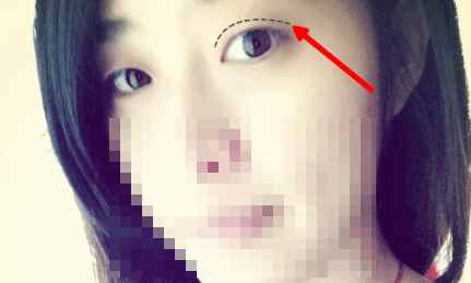 韩式三点定位双眼皮,韩式双眼皮三点定位设计