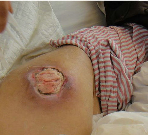 褥疮易缠身防患于未然