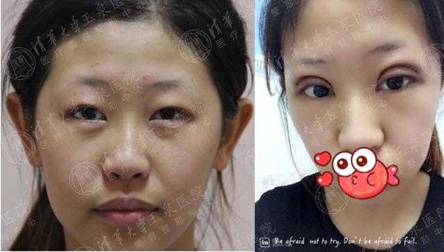 割双眼皮需要问医生哪些问题,割双眼皮会不会很痛呢