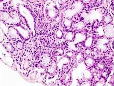 结缔组织病预兆,结缔组织病50岁死亡率高吗