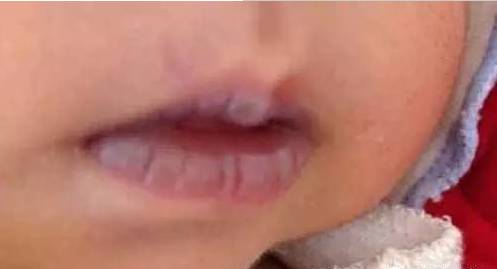 嘴唇上有几种颜色是什么病,嘴唇肿要警惕四种慢性病