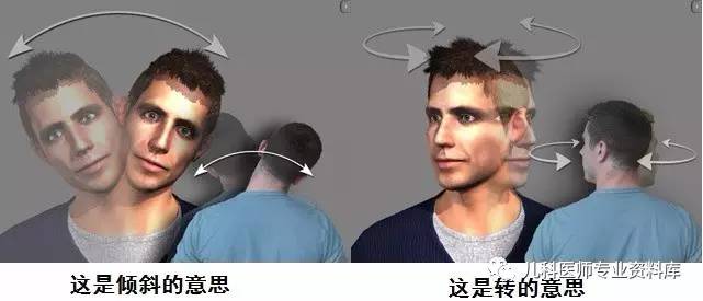 痉挛性斜颈患者说出了大秘密,痉挛性斜颈脖子歪照片