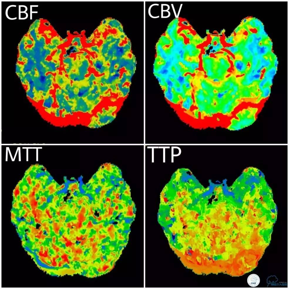 天坛周记|基底动脉狭窄合并动脉瘤血管内介入治疗一例