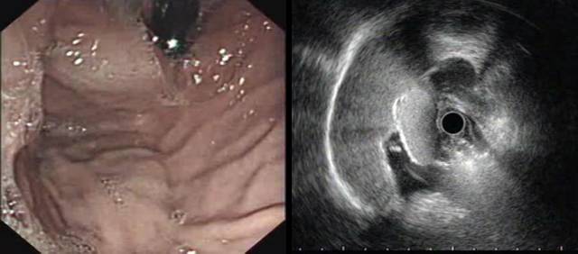 当EUS遇到“假瘤子”(二)——都是“隔壁老王”惹的祸(毗邻外压)