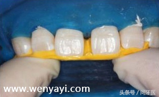 门牙有缝是什么说法,门牙有缝怎么办如何补救