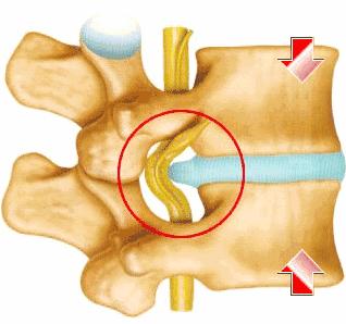 腰痛反射性腰痛,肾虚腰痛腰痛宁