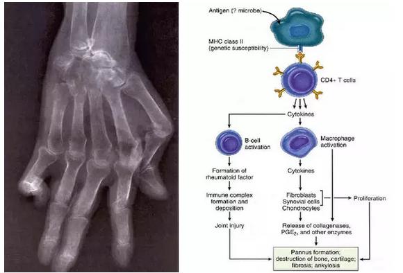 结缔组织病预兆,结缔组织病50岁死亡率高吗