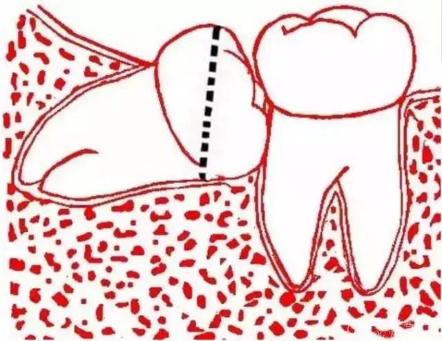 智齿的治疗过程,智齿要上下成对拔除吗