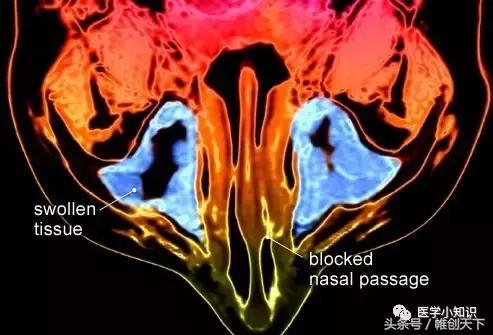 鼻窦炎引起头痛怎么治疗,鼻窦炎的症状及食疗视频播放