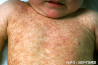 幼儿急疹的斑丘疹多久消失,幼儿急疹是否有痒的案例