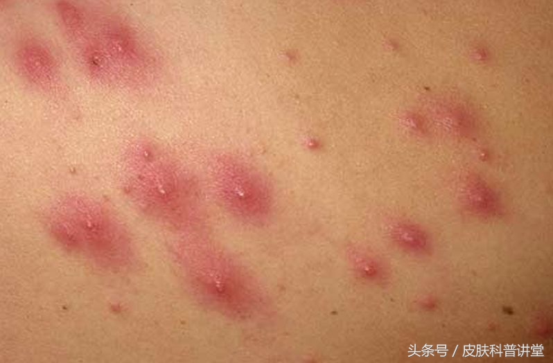 皮肤科普健康知识讲座,皮肤病种类图毛囊炎