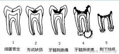 蛀牙会散发臭味吗,抠蛀牙洞臭