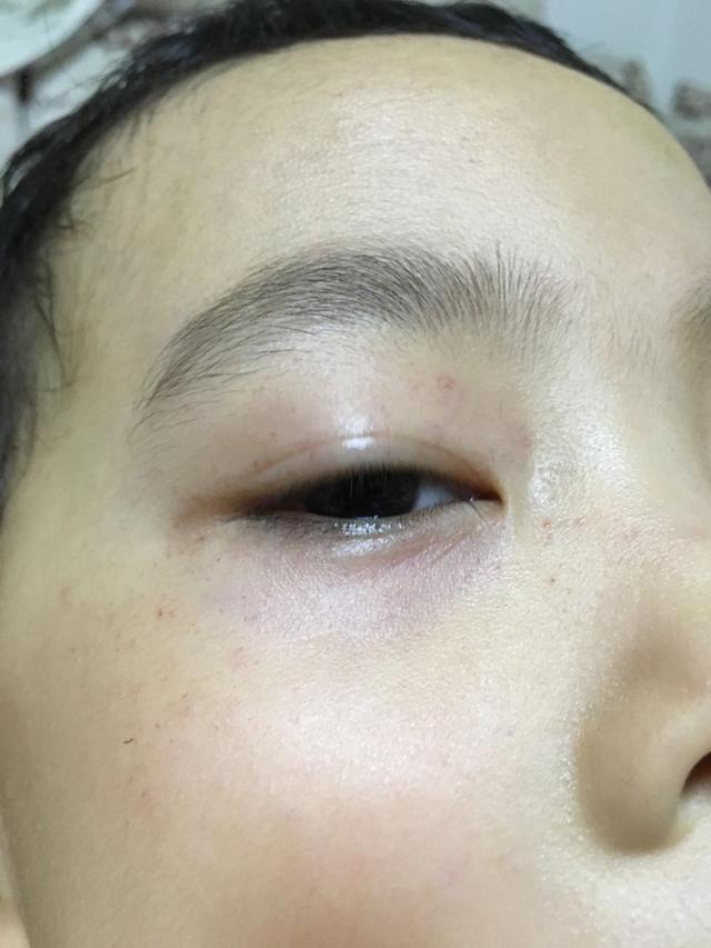 女生身上莫名其妙有淤青牙龈出血,女子突然皮下出血是瑜伽惹的祸