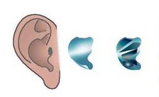 耳软骨隆鼻垫鼻尖缺点,隆鼻耳软骨垫鼻尖发白