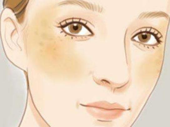 肝斑和褐青色斑的区别,褐青色斑和黄褐斑哪个严重