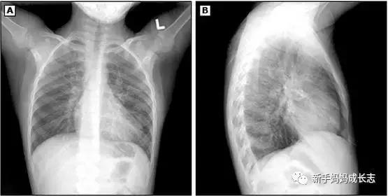 新生儿科的医生怎么治疗肺炎,医生如何诊断儿童肺炎