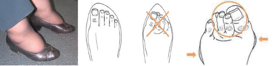 糖尿病足的预防重于治疗,糖尿病足病预防案例