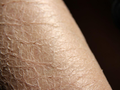 一换季手就裂开干燥脱皮,换季脸干燥脱皮紧绷刺痛