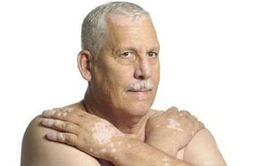 白癜风吃啥有助于治疗,白癜风应该注意什么饮食